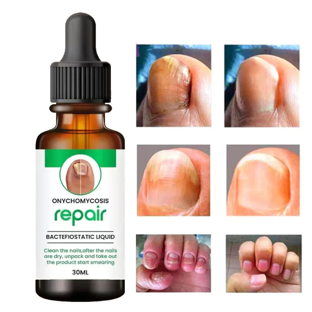 Nail Repair Serum (📢Buy 1 Get 1 FREE) MAN & WOMAN